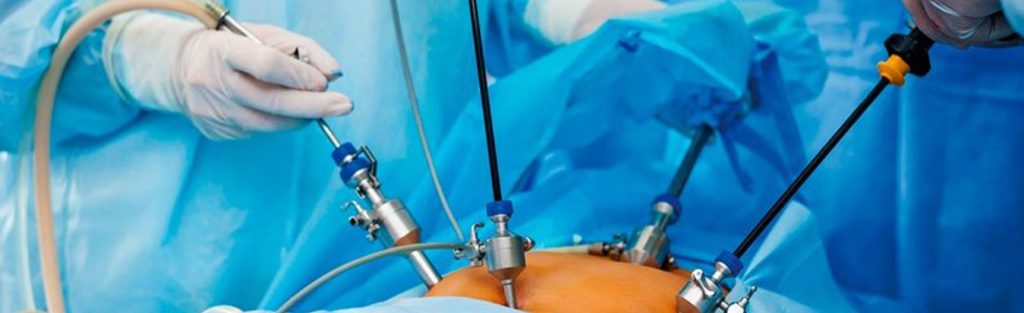 Cirurgia por videolaparoscopia no câncer colorretal