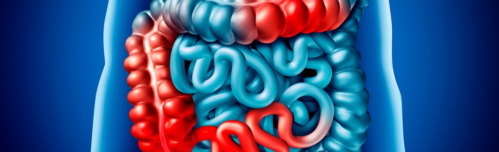Obstrução intestinal é um problema sério ou não? Entenda
