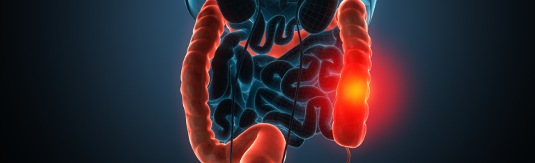 Curiosidades sobre o câncer de intestino: o que é fundamental saber?