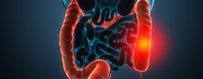 Curiosidades sobre o câncer de intestino: o que é fundamental saber?