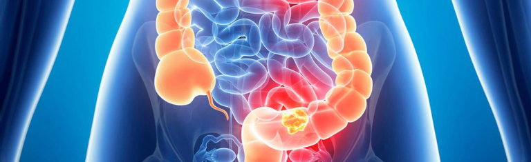Os sintomas do câncer de intestino podem variar de acordo com a localização dele? Descubra
