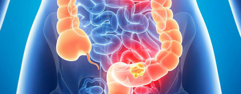 Os sintomas do câncer de intestino podem variar de acordo com a localização dele? Descubra